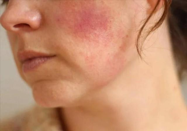 Plasma Lạnh và Laser trong điều trị da: Phương pháp nào tốt hơn?- Ảnh 6.