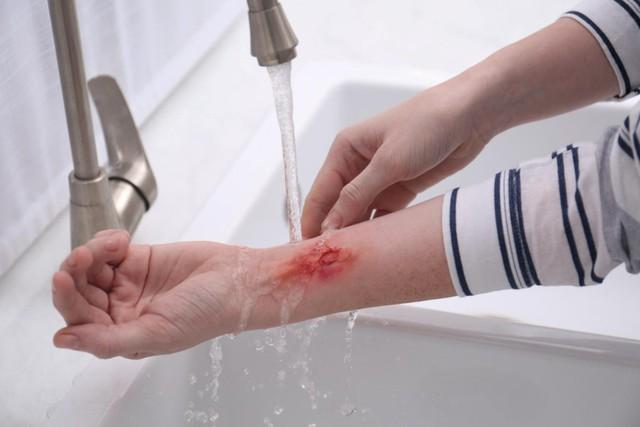 Hướng dẫn sử dụng chai xịt vết thương Hemacut Spray giúp mau lành và ngăn ngừa sẹo- Ảnh 7. Hướng dẫn sử dụng chai xịt vết thương Hemacut Spray giúp mau lành và ngăn ngừa sẹo- Ảnh 7.