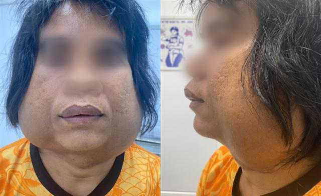 Choáng: Nam thanh niên sống cùng 2 khối u khổng lồ trên mặt suốt 10 năm- Ảnh 1.