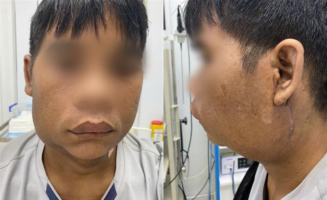 Choáng: Nam thanh niên sống cùng 2 khối u khổng lồ trên mặt suốt 10 năm- Ảnh 4.