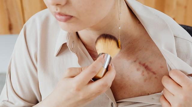 Cuộc chiến với sẹo: Nắm ‘vũ khí’ khoa học chống sẹo sau phẫu thuật- Ảnh 1.