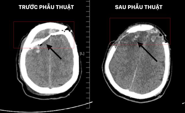 Vỡ sọ, dập não sau xô xát, nam thanh niên được cứu sống đầy ngoạn mục - Ảnh 2. Vỡ sọ, dập não sau xô xát, nam thanh niên được cứu sống đầy ngoạn mục - Ảnh 2.