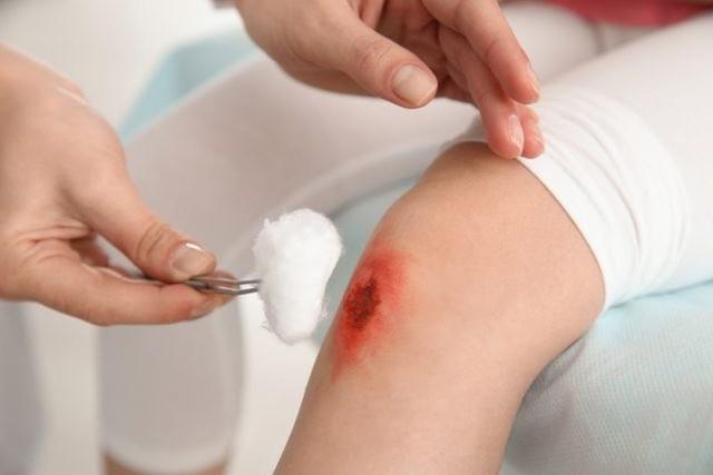 Phòng ngừa nhiễm trùng từ vết thương hở: Bật mí từ chuyên gia da liễu- Ảnh 1. Phòng ngừa nhiễm trùng từ vết thương hở: Bật mí từ chuyên gia da liễu- Ảnh 1.