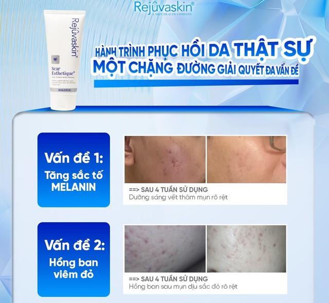 Skincare phục hồi da sau mụn tốt ngừa sẹo rỗ thâm đỏ sau 8 tuần- Ảnh 1. Skincare phục hồi da sau mụn tốt ngừa sẹo rỗ thâm đỏ sau 8 tuần- Ảnh 1.