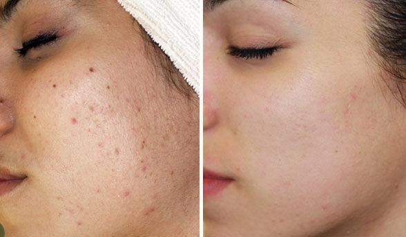 Vì sao Scar Esthetique là sản phẩm dành cho thâm đỏ sau mụn? - Ảnh 2.