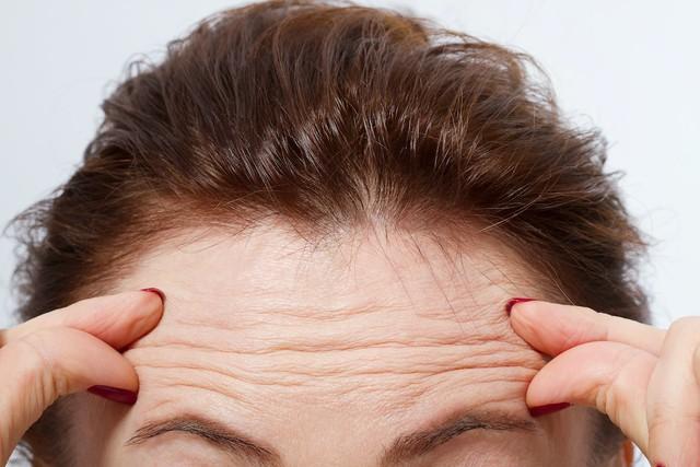 Nếp nhăn trán tuổi 20+ chính là ‘tín hiệu vũ trụ’ báo động lão hóa ‘gõ cửa’- Ảnh 2.