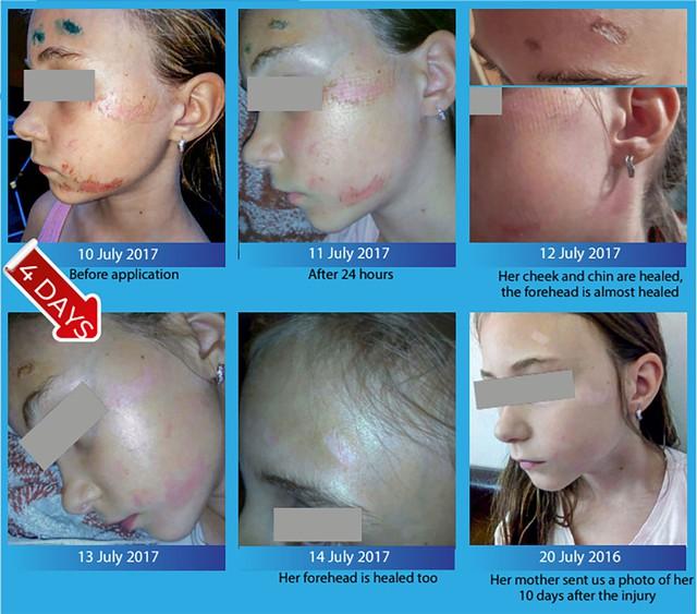 Khi nào nên chọn Hema để chăm sóc vết thương?- Ảnh 3. Khi nào nên chọn Hema để chăm sóc vết thương?- Ảnh 3.