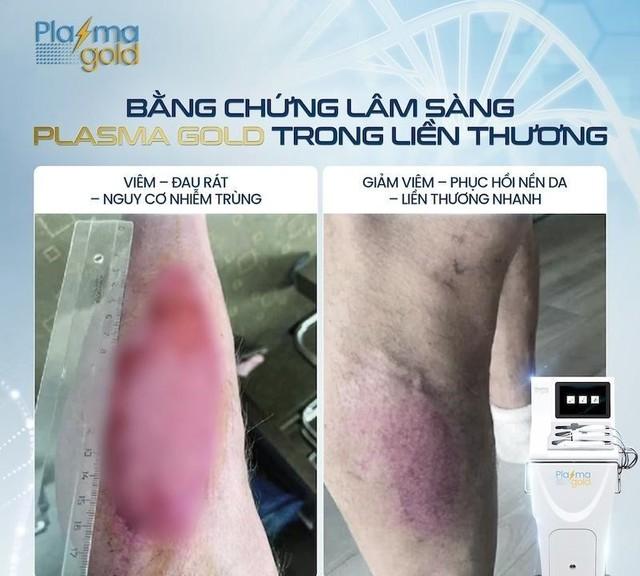 Plasma Gold - Từ phục hồi vết thương đến chuẩn mực thẩm mỹ cao cấp- Ảnh 3. Plasma Gold - Từ phục hồi vết thương đến chuẩn mực thẩm mỹ cao cấp- Ảnh 3.