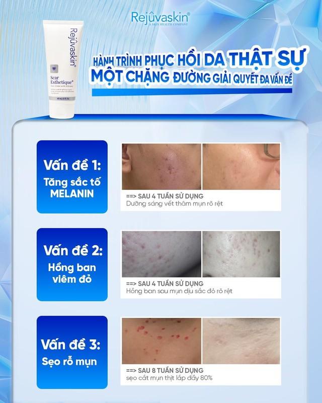Da hết mụn mà vẫn loang lổ đỏ hồng? 90% chị em đang bỏ qua bước này! - Ảnh 5.