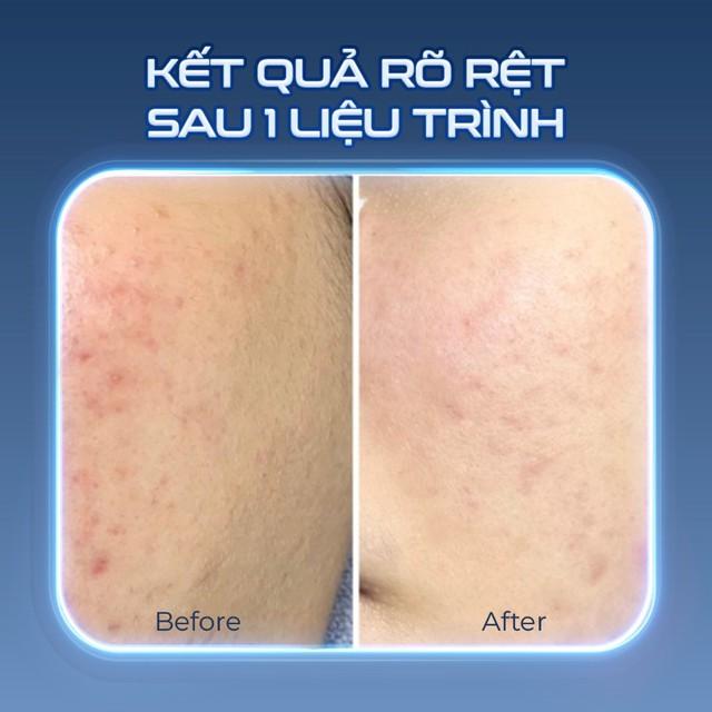 Công nghệ Plasma Lạnh: Lựa chọn hàng đầu của spa, clinic cho làn da đẹp! - Ảnh 5.