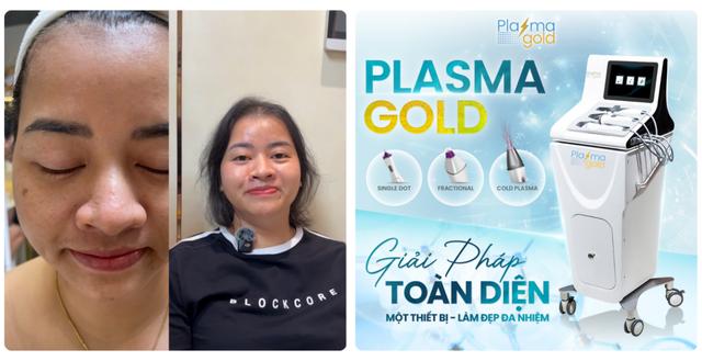 Plasma Lạnh trị sẹo rỗ và se khít lỗ chân lông như thế nào?- Ảnh 6.
