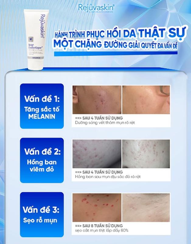 Sử dụng kem mờ sẹo chuẩn y khoa hiệu quả tăng gấp 3 ngừa tái phát- Ảnh 8. Sử dụng kem mờ sẹo chuẩn y khoa hiệu quả tăng gấp 3 ngừa tái phát- Ảnh 8.