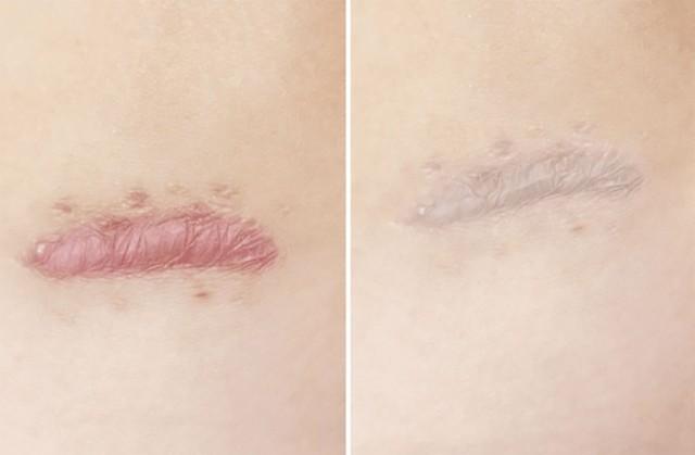 Những điều bạn cần biết trước khi chăm sóc sẹo lồi/phì đại - Ảnh 1.