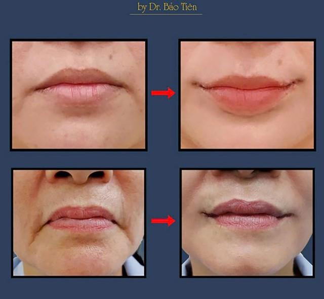 Smile Lipt bí quyết tạo khóe môi cười tự nhiên của bác sĩ Bảo Tiên- Ảnh 1.