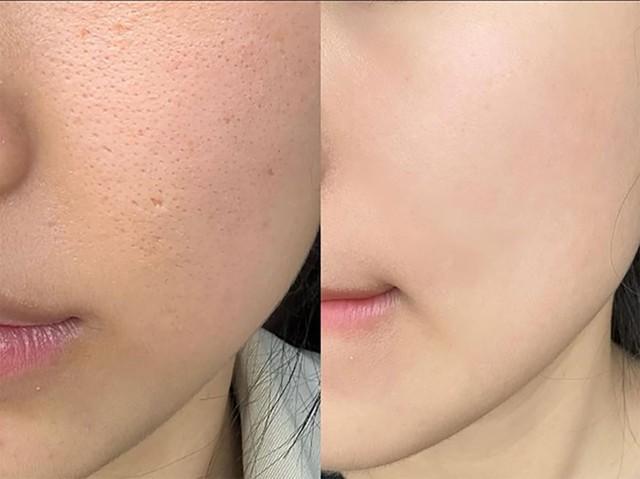 Cẩm nang chăm sóc da sẹo rỗ phục hồi phẳng mịn sau laser bóc tách- Ảnh 1.