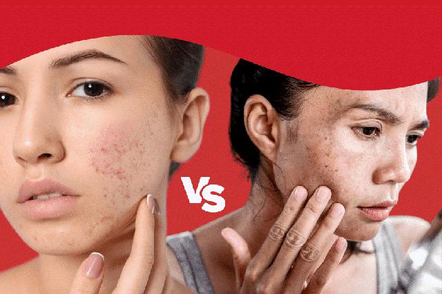 Hết thâm đỏ sau mụn nhanh: Cách chọn sản phẩm chuẩn khoa học- Ảnh 1. Hết thâm đỏ sau mụn nhanh: Cách chọn sản phẩm chuẩn khoa học- Ảnh 1.