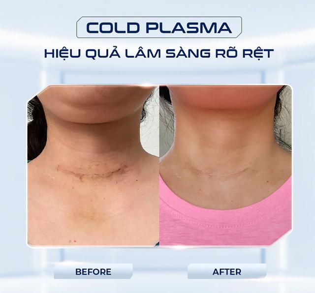 Máy Plasma Lạnh là gì? Công dụng của Plasma Lạnh trong thẩm mỹ?- Ảnh 4. Máy Plasma Lạnh là gì? Công dụng của Plasma Lạnh trong thẩm mỹ?- Ảnh 4.