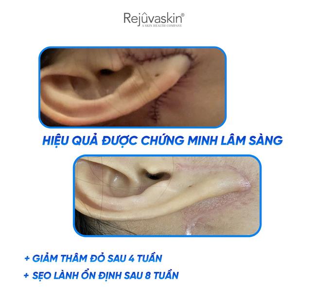 Bắt trend chăm sẹo không sợ lồi/phì đại đang có mặt trong viện thẩm mỹ nổi danh- Ảnh 6.