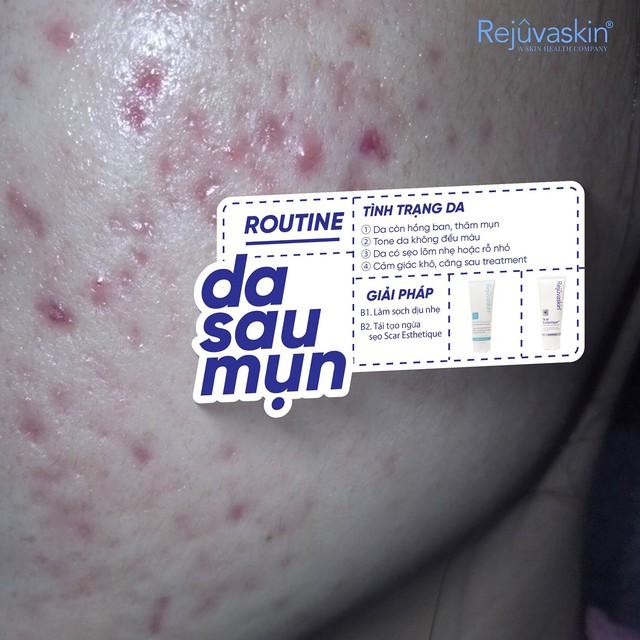 Mụn thâm đen cứng đầu, lâu năm cải thiện bật sáng đều màu sau 7 ngày- Ảnh 9.
