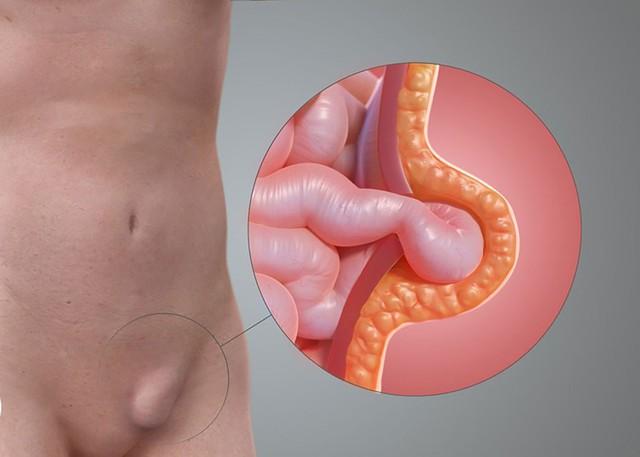 Người đàn ông 51 tuổi suýt gặp biến chứng nguy hiểm vì khối phồng vùng bẹn- Ảnh 1. Người đàn ông 51 tuổi suýt gặp biến chứng nguy hiểm vì khối phồng vùng bẹn- Ảnh 1.