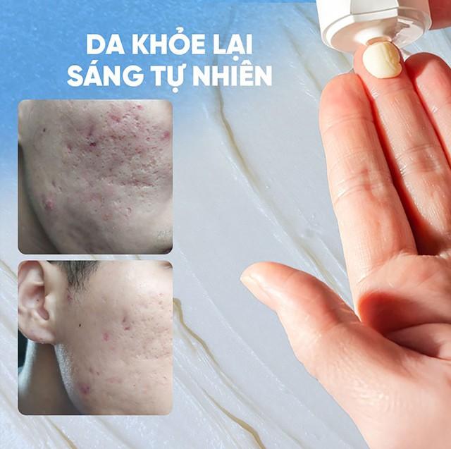 Ghim ngay: Tuýp kem đang được Gen Z ‘vote cao’ cho sẹo mụn! - Ảnh 10.