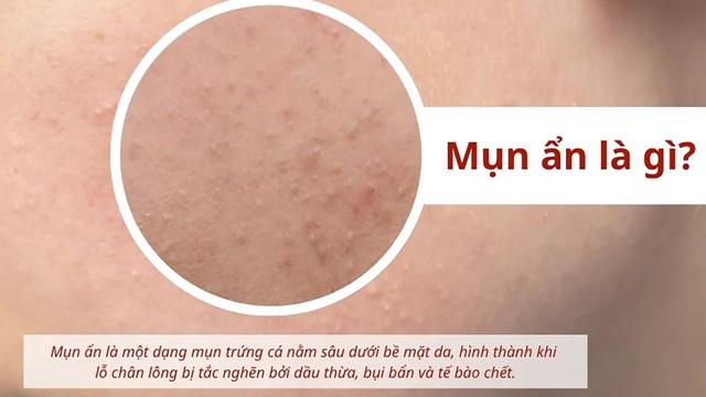 Mụn sâu tới đâu cũng đánh bật, không sẹo nhờ cách ngừa mụn ẩn chuẩn chuyên gia- Ảnh 2.
