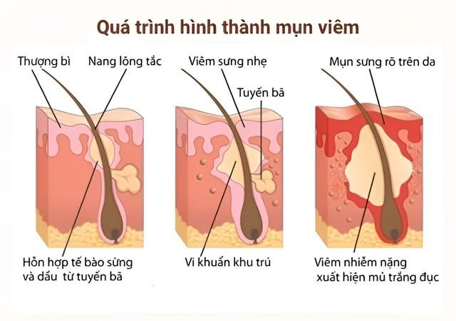 Da sau mụn: Giải mã tiến trình phục hồi sinh học dưới góc độ chuyên gia- Ảnh 2. Da sau mụn: Giải mã tiến trình phục hồi sinh học dưới góc độ chuyên gia- Ảnh 2.