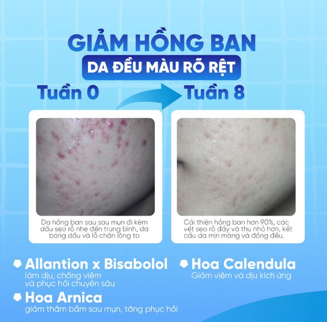 Hướng dẫn sử dụng kem làm mờ sẹo rỗ Rejuvaskin Scar Esthetique đúng chuẩn y khoa - Ảnh 2.