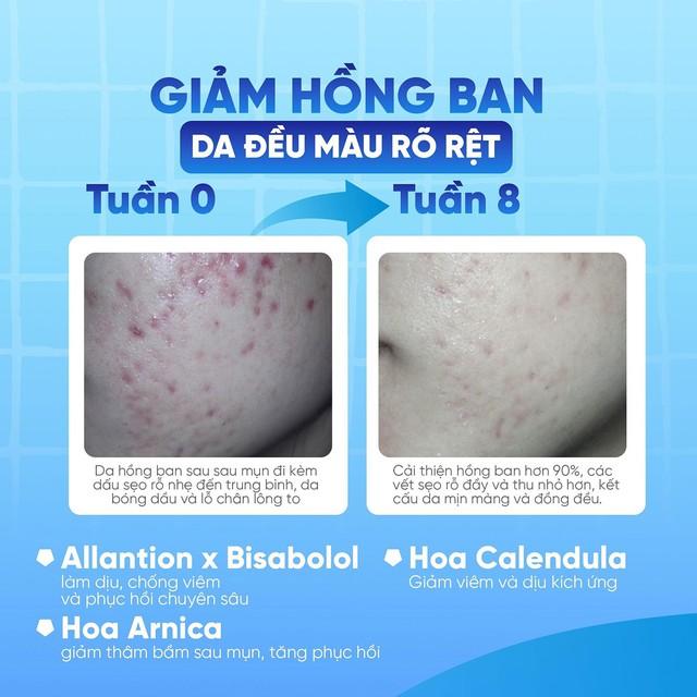 Da sau mụn: Giải mã tiến trình phục hồi sinh học dưới góc độ chuyên gia- Ảnh 4. Da sau mụn: Giải mã tiến trình phục hồi sinh học dưới góc độ chuyên gia- Ảnh 4.