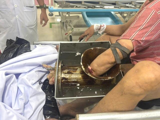 TP.HCM: Bị máy xay thịt 'nuốt chửng' tay, phải đưa cả người và máy vào phòng mổ- Ảnh 1. TP.HCM: Bị máy xay thịt 'nuốt chửng' tay, phải đưa cả người và máy vào phòng mổ- Ảnh 1.