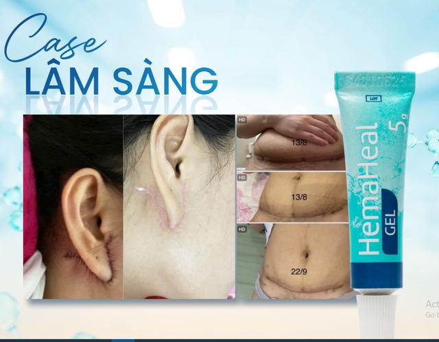 Cách sử dụng xịt vết thương hở Hema chuẩn y khoa, da phục hồi nhanh- Ảnh 8. Cách sử dụng xịt vết thương hở Hema chuẩn y khoa, da phục hồi nhanh- Ảnh 8.