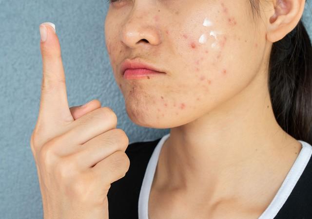 Da vùng má dễ bị thâm mụn? Cách chăm sóc da giúp da đều màu hơn- Ảnh 1. Da vùng má dễ bị thâm mụn? Cách chăm sóc da giúp da đều màu hơn- Ảnh 1.