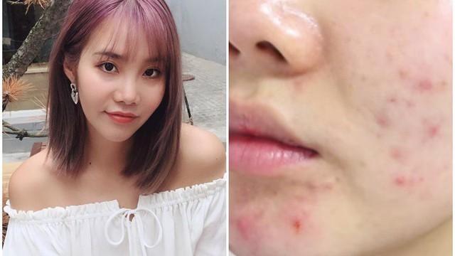 Sát Tết mới cuống skincare: 5 sai lầm khiến da ‘banh’ không kịp phục hồi- Ảnh 2. Sát Tết mới cuống skincare: 5 sai lầm khiến da ‘banh’ không kịp phục hồi- Ảnh 2.