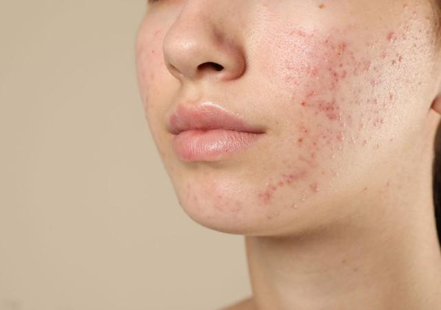 Da vùng má dễ bị thâm mụn? Cách chăm sóc da giúp da đều màu hơn- Ảnh 2. Da vùng má dễ bị thâm mụn? Cách chăm sóc da giúp da đều màu hơn- Ảnh 2.