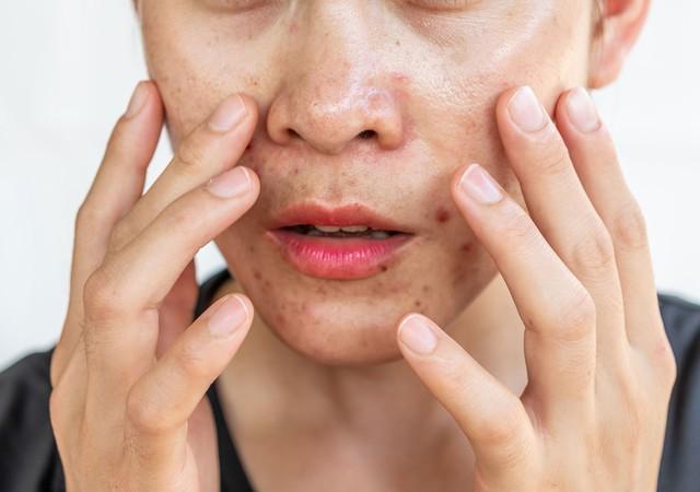 Da vùng má dễ bị thâm mụn? Cách chăm sóc da giúp da đều màu hơn- Ảnh 3. Da vùng má dễ bị thâm mụn? Cách chăm sóc da giúp da đều màu hơn- Ảnh 3.