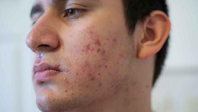 Nam giới bị sẹo rỗ: Khi nào da còn khả năng tăng sinh collagen để cải thiện?- Ảnh 1. Nam giới bị sẹo rỗ: Khi nào da còn khả năng tăng sinh collagen để cải thiện?- Ảnh 1.