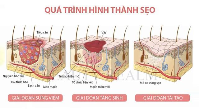 Nam giới bị sẹo rỗ: Khi nào da còn khả năng tăng sinh collagen để cải thiện?- Ảnh 2. Nam giới bị sẹo rỗ: Khi nào da còn khả năng tăng sinh collagen để cải thiện?- Ảnh 2.