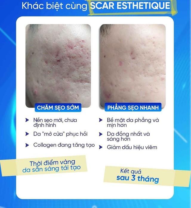 Nam giới bị sẹo rỗ: Khi nào da còn khả năng tăng sinh collagen để cải thiện?- Ảnh 3. Nam giới bị sẹo rỗ: Khi nào da còn khả năng tăng sinh collagen để cải thiện?- Ảnh 3.