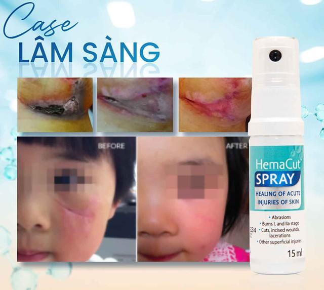 Sử dụng chai xịt vết thương khi nào để hạn chế nhiễm trùng, sẹo xấu?- Ảnh 6.
