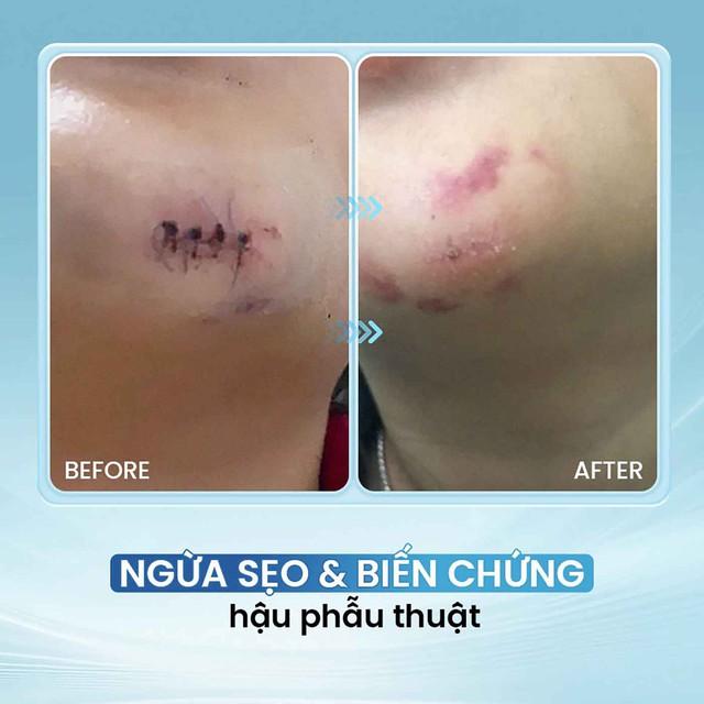 Sử dụng chai xịt vết thương khi nào để hạn chế nhiễm trùng, sẹo xấu?- Ảnh 9.