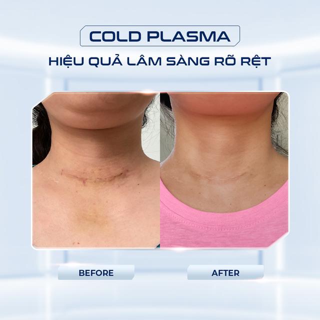 Cold Plasma: Công nghệ giúp kiểm soát nhiễm khuẩn trong thẩm mỹ - Ảnh 2.