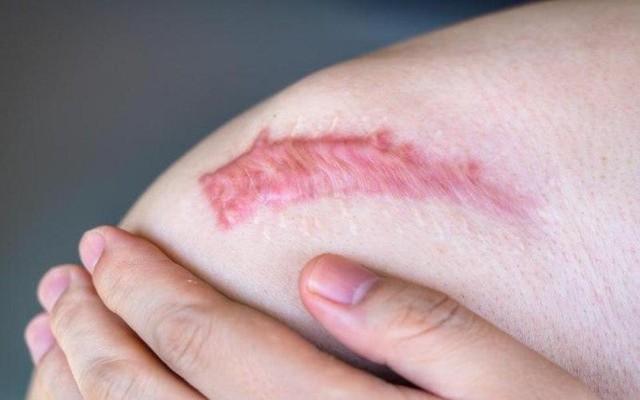 Giải mã ‘cuộc chiến’ vi mô tại vết thương: Khi sự kiểm soát quyết định phục hồi - Ảnh 2.
