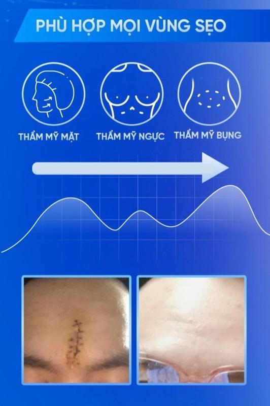 Gel Rejuvasil giúp ngăn ngừa sẹo mới và làm mờ sẹo lồi phẫu thuật có tốt không? - Ảnh 6.