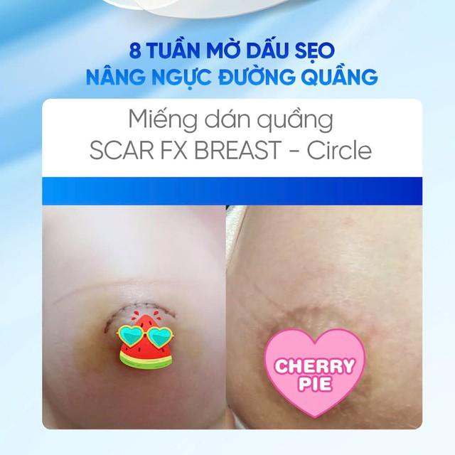Phẫu thuật treo sa trễ dùng miếng dán silicone nào để da phẳng như chưa dao kéo?- Ảnh 7. Phẫu thuật treo sa trễ dùng miếng dán silicone nào để da phẳng như chưa dao kéo?- Ảnh 7.