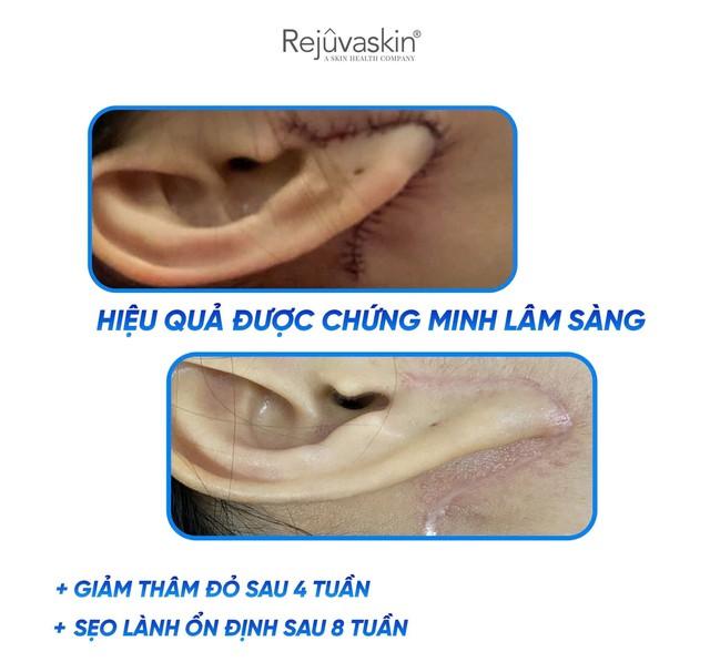 Chuyên gia gợi ý cách dùng kem mờ sẹo lồi hiệu quả sau khoảng 4 tuần- Ảnh 9.