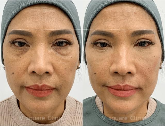 Bí mật đằng sau bọng mắt và quầng thâm đen dưới mắt- Ảnh 1. Bí mật đằng sau bọng mắt và quầng thâm đen dưới mắt- Ảnh 1.