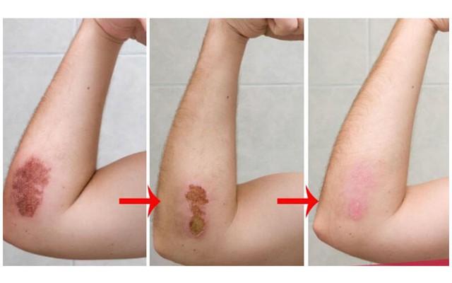 Cách dùng kem bôi vết thương hở tưởng đơn giản nhưng nhiều người vẫn làm sai - Ảnh 2.