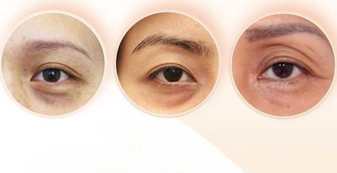 Bí mật đằng sau bọng mắt và quầng thâm đen dưới mắt- Ảnh 3. Bí mật đằng sau bọng mắt và quầng thâm đen dưới mắt- Ảnh 3.