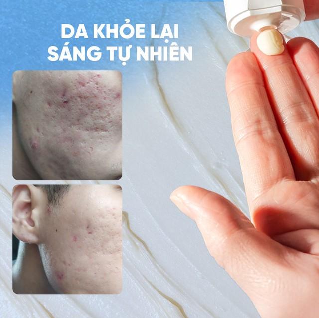 Review chi tiết kem Scar Esthetique làm mờ sẹo rỗ do mụn có tốt không?- Ảnh 1. Review chi tiết kem Scar Esthetique làm mờ sẹo rỗ do mụn có tốt không?- Ảnh 1.