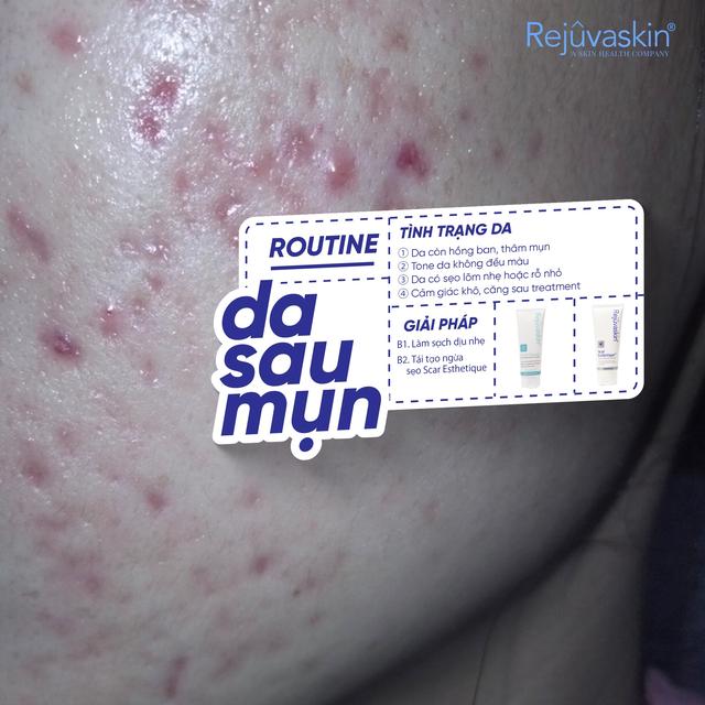 Vì sao skincare rất nhiều nhưng da sau mụn vẫn không đẹp lên? - Ảnh 4.
